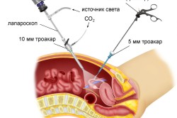 Лапароскопия при фолликулярной кисте
