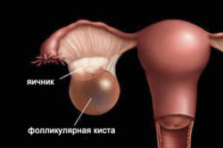 Схема фолликулярной кисты
