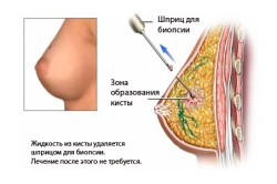 Биопсия кисты груди