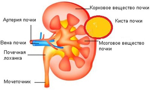 Схематическое изображение кисты на почке