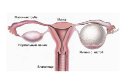 Схема кисты яичника