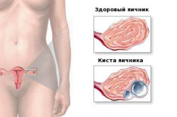 Здоровый яичник и киста