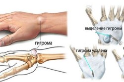 Вид гигромы и ее удаление