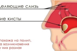 Образование кисты в гайморовой пазухе носа