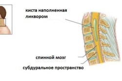 Схема периневральной кисты