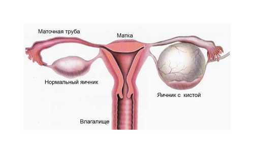 Схема кисты яичника