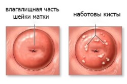 Наботовы кисты шейки матки