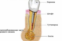 Схема кисты зуба