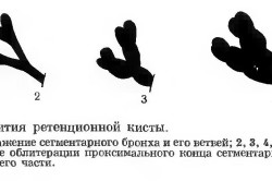 Ретенционная киста легкого