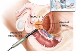 Узи простаты