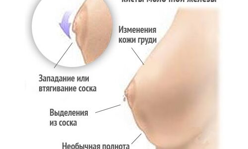 От чего и где у женщин появляется киста?