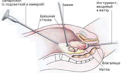 Основные проявления и методы лечения эндометриоидной кисты яичника
