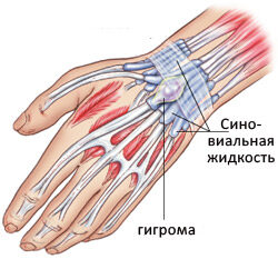 Классификация и лечение синовиальных кист