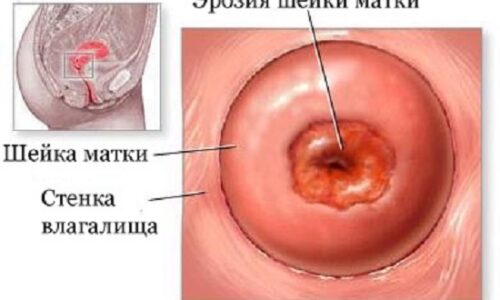 Что такое наботовы кисты шейки матки?